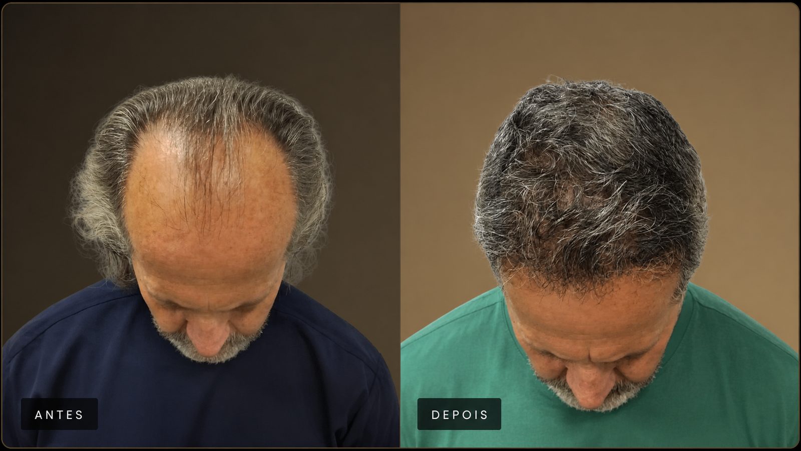 Resultado de transplante capilar — paciente masculino