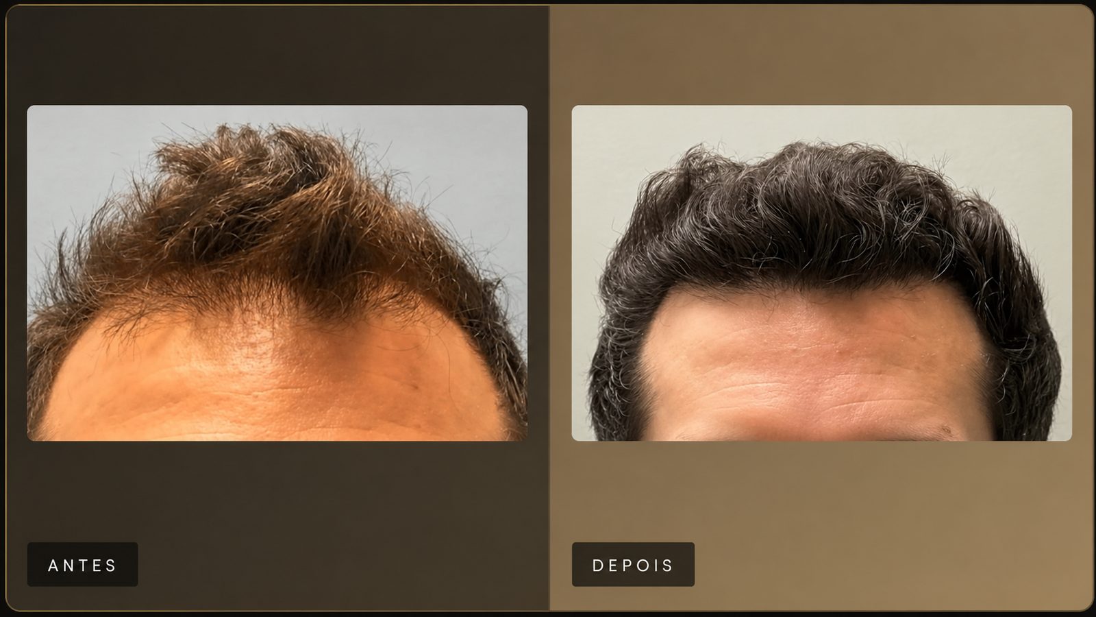 Resultado de transplante capilar — Dra. Hilda Alfaro