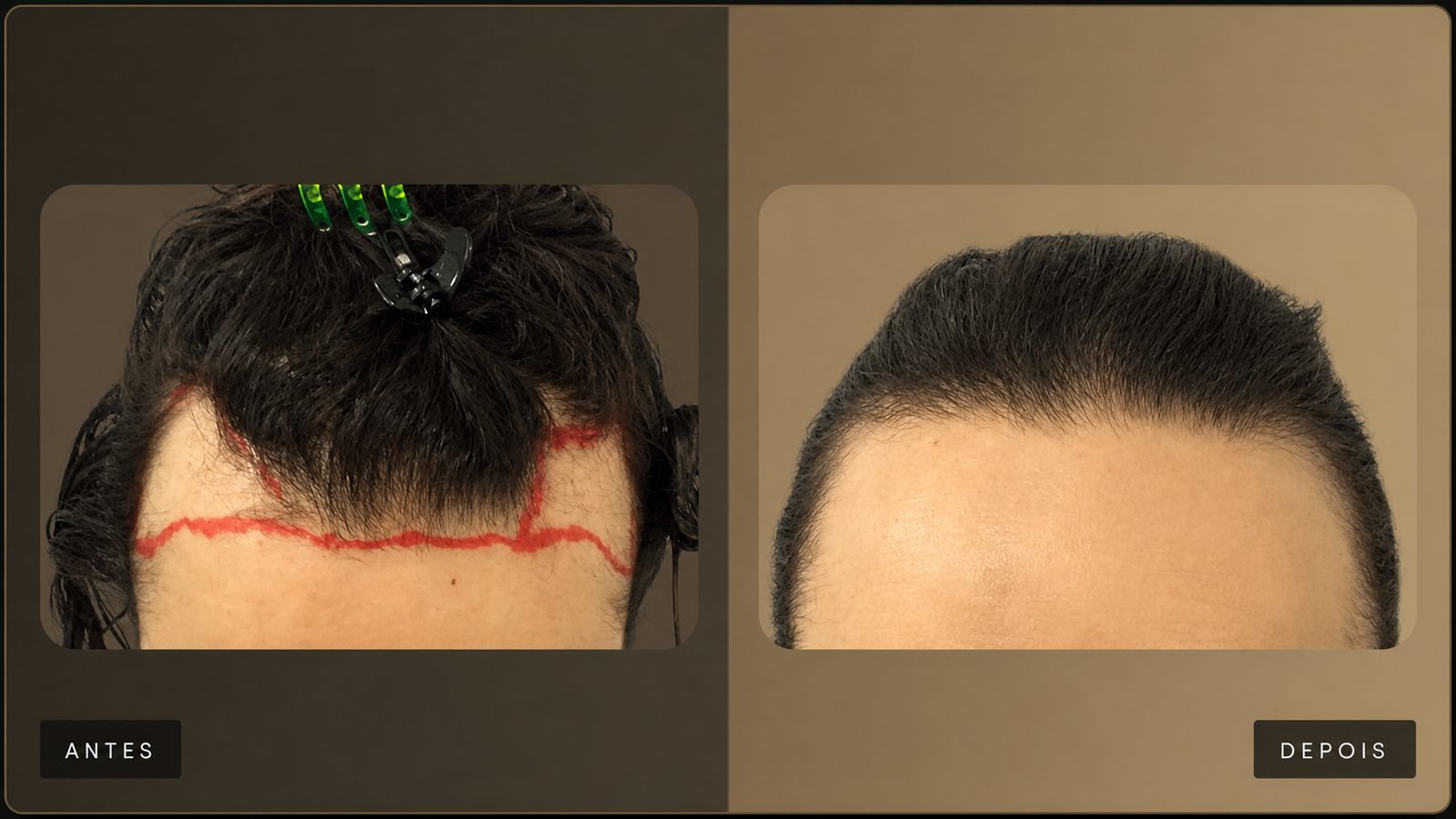 Resultado de transplante capilar — Dra. Hilda Alfaro