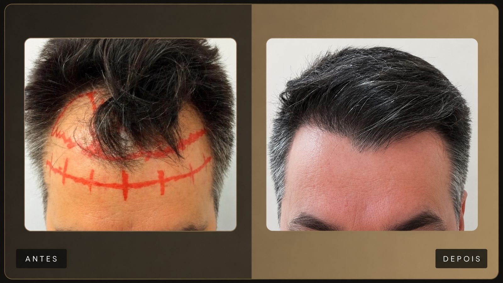 Resultado de transplante capilar — Dra. Hilda Alfaro